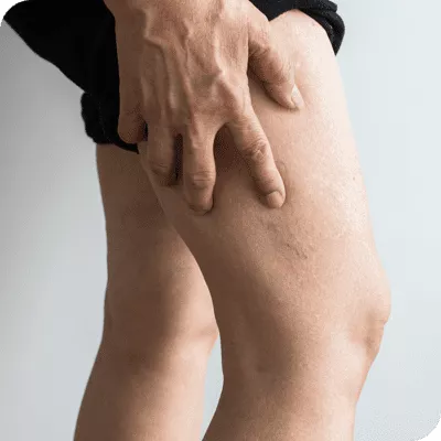 Spider Vein Treatments (Sclerotherapy)