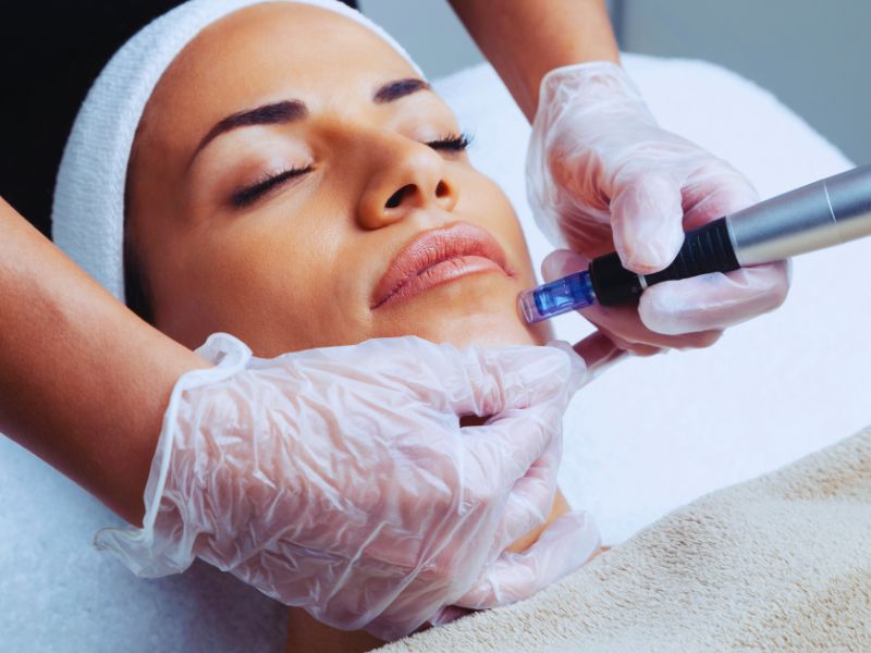 microneedling image 1