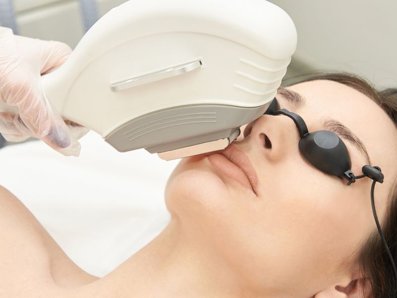 what is ipl removal image