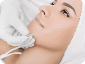 Non-Surgical PDO (Polydioxanone) Thread Lift