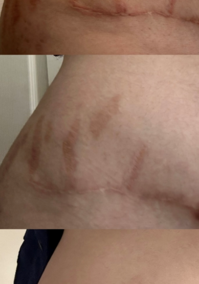 stretch mark reduction